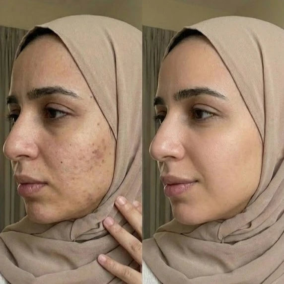 كريم يوباي الأصلي | الكبير بتأثيره على الكلف والتصبغات + هدية مجانية