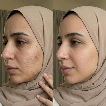 كريم يوباي الأصلي | الكبير بتأثيره على الكلف والتصبغات + هدية مجانية